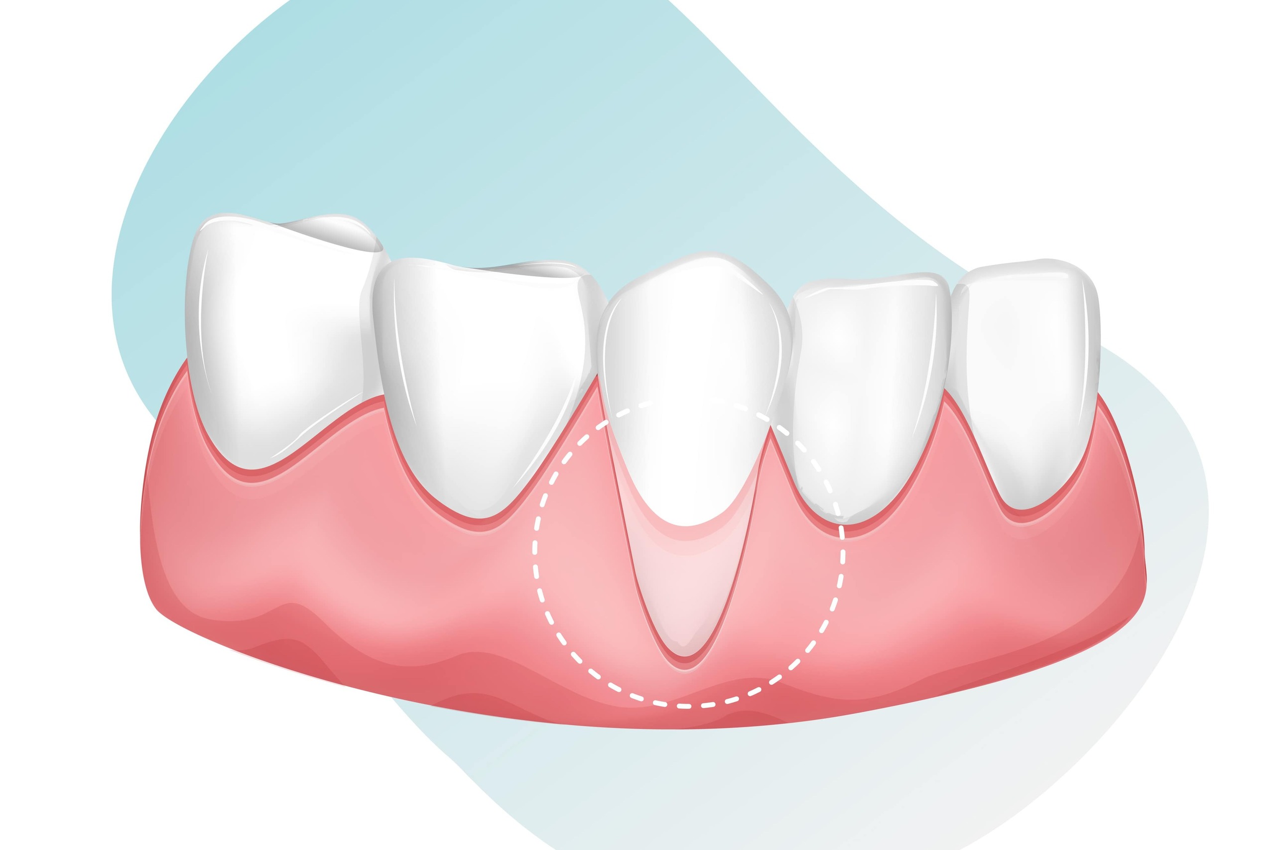 Receding Gums: Causes, Prevention, and Treatment