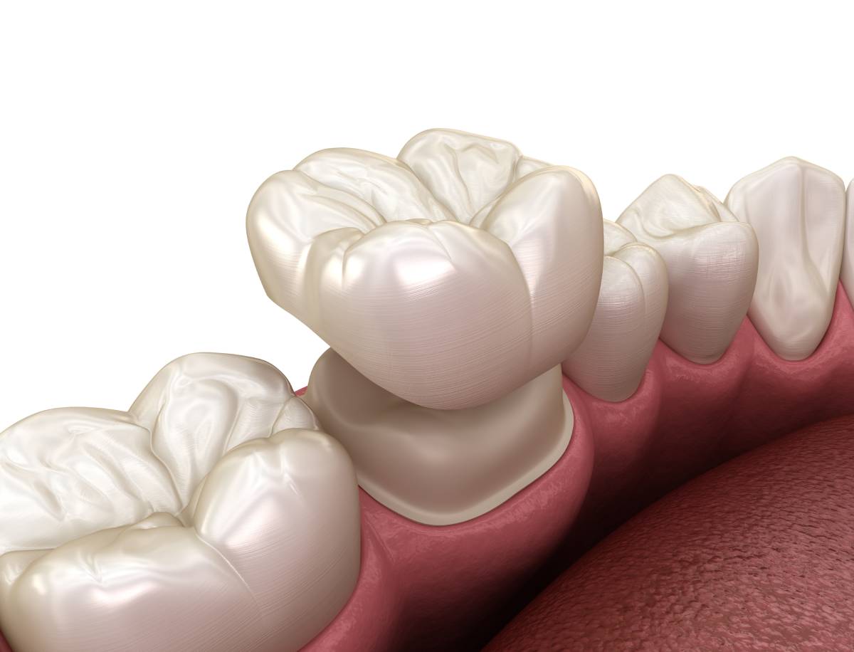 When Should You Consider A Dental Crown? Signs You Shouldn&# ;t Ignore