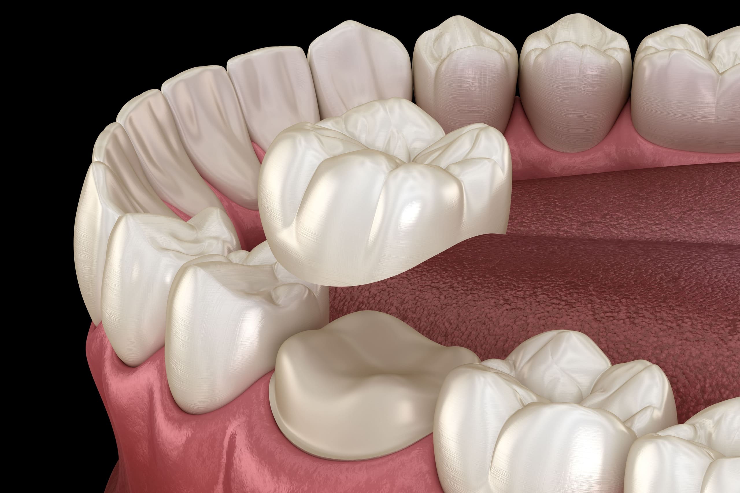 How Can Dental Crowns Restore the Aesthetics and Function of Your Smile?