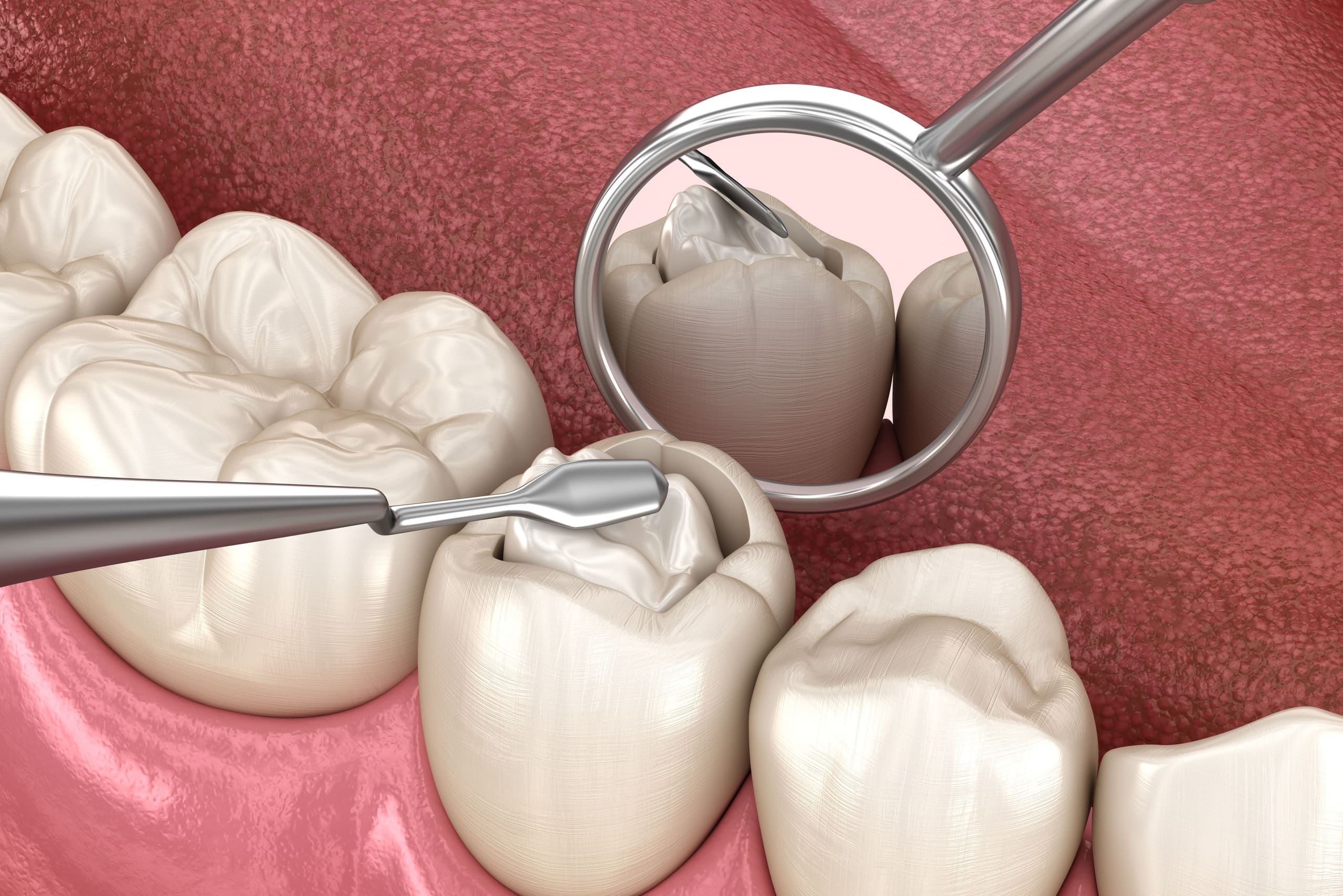 The Evolution of Tooth-Colored Fillings