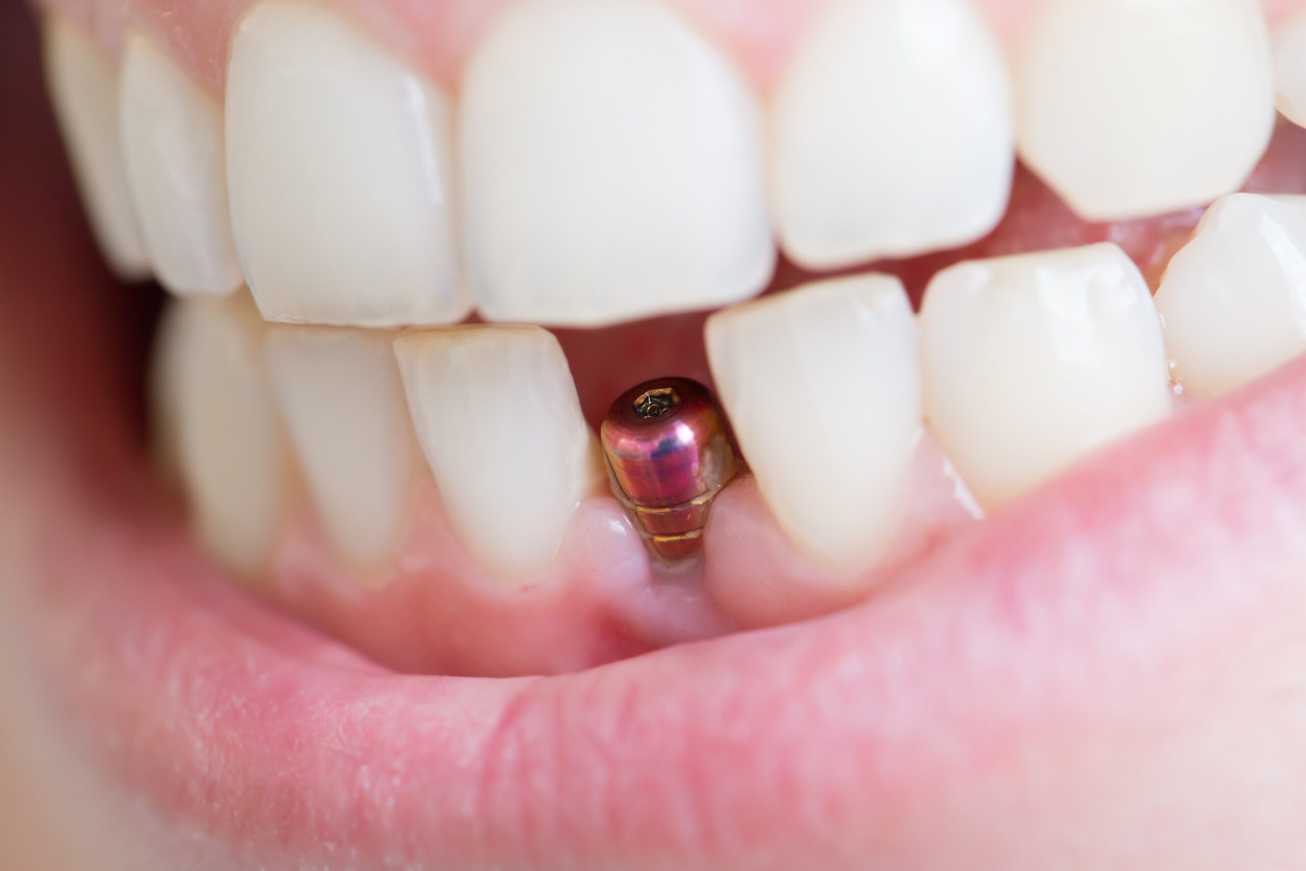 Dental-Implants-scaled