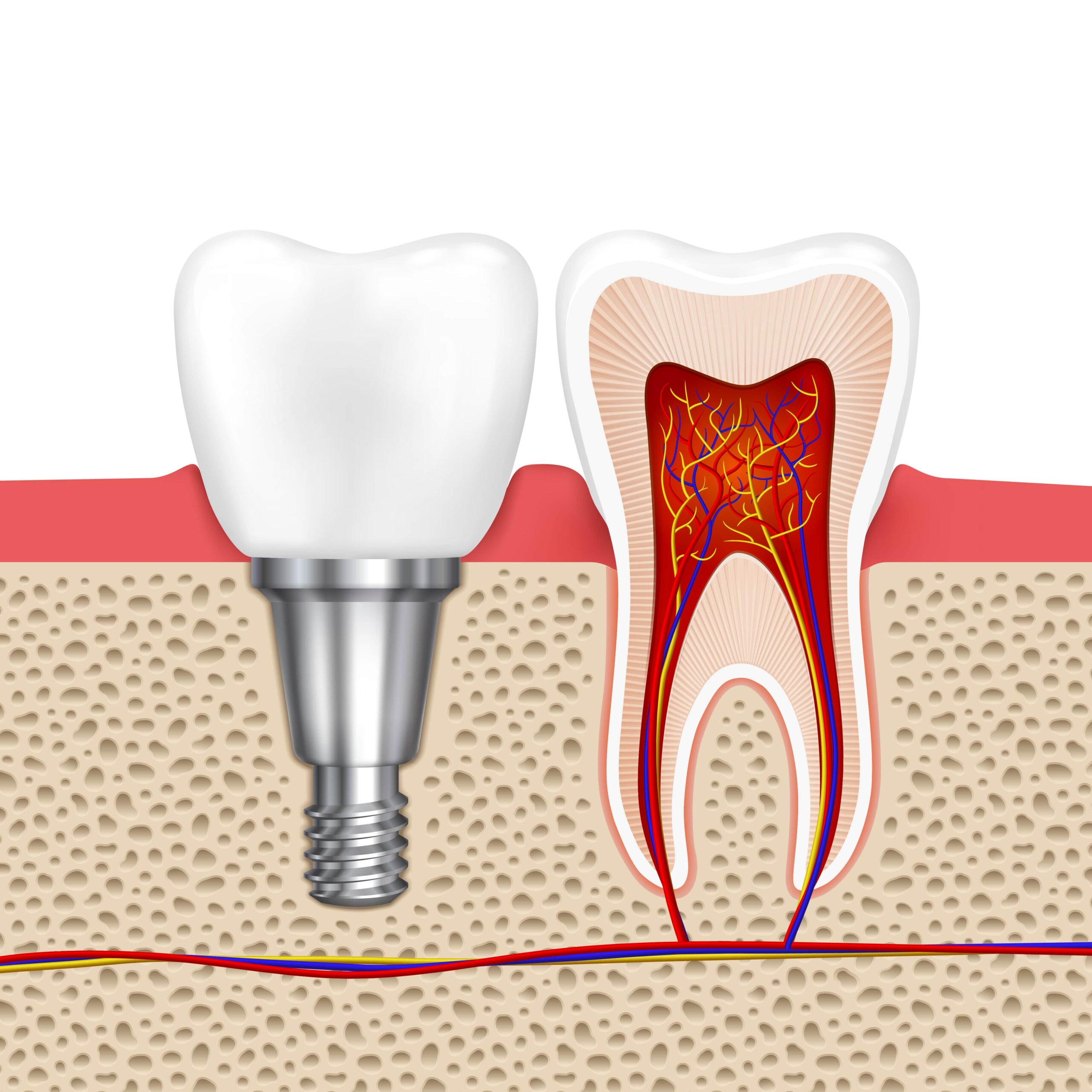 Root Canal vs. Dental Implant: Which One Is Right for Me?