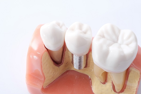 dental implant Madison, MS